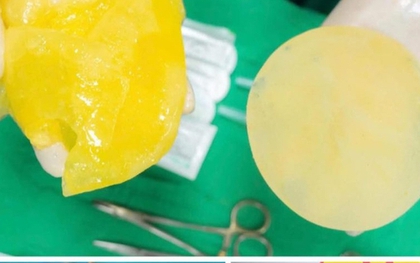 Phụ nữ đã "trùng tu" vòng 1 có nên chơi pickleball?