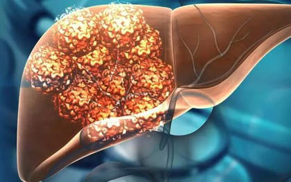 Khối u gan 6 cm đột nhiên biến mất sau khi chuyện này xảy ra