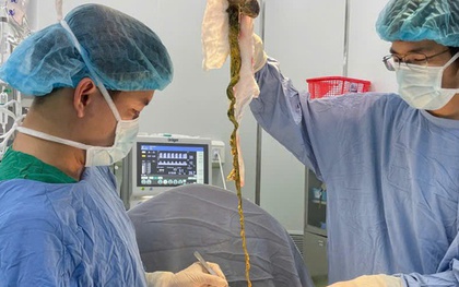 Bé trai phải lên bàn mổ vì ăn tóc, bác sĩ cảnh báo tình trạng y khoa hiếm gặp