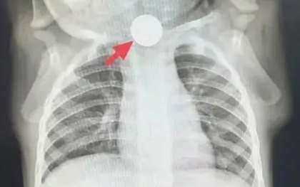 Bé trai 1 tuổi bỏ ăn cả tuần, nguyên nhân được phát hiện khiến bà nội phải thốt lên: "Đúng là lỗi của tôi"