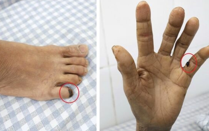 Người phụ nữ 60 tuổi "cứng hàm" suýt mất mạng vì bị gà đá