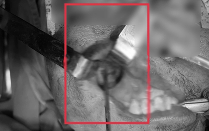 Nấm đen ăn mòn xoang hàm người đàn ông khỏe mạnh