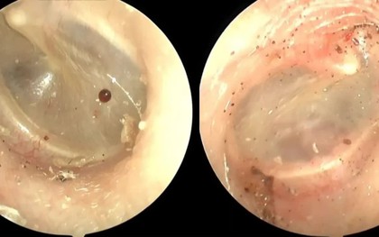 Đau, khó chịu tai kéo dài, phát hiện bọ chó sống trong tai