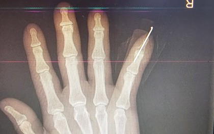 Nối thành công ngón tay đứt lìa cho bệnh nhân