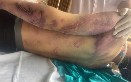 Bộ Y tế yêu cầu rà soát các cơ sở trợ giúp xã hội sau vụ học viên tử vong ở Quảng Ninh