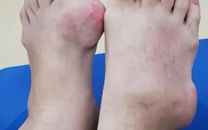 Khớp tay chân biến dạng đáng sợ vì biến chứng bệnh gout