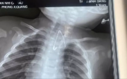 Trẻ bị thủng tá tràng vì nuốt que kẹo mút