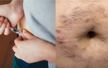Bác sĩ Nội tiết - Đái tháo đường cảnh báo những người tiêm insulin "vòng quanh rốn"