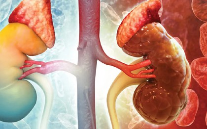 Thói quen hàng đầu gây hại cho thận: Nhiều người làm từ khi còn trẻ mà không biết