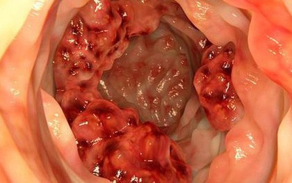Bác sĩ cảnh báo 5 dấu hiệu ung thư đại trực tràng thường bị bỏ sót