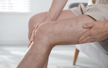 Bị giãn tĩnh mạch ở tuổi 30: Chuyên gia Nhật hướng dẫn cách bảo vệ đôi chân chỉ với 3 phút, ai hay ngồi hoặc đứng trong thời gian dài nên học