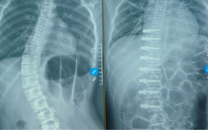 Việt Nam lần đầu tiên phẫu thuật nắn chỉnh vẹo cột sống không ghép xương: Cột sống bé gái thẳng tắp sau ca mổ chưa từng có