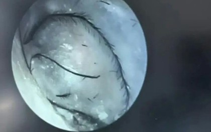 Người phụ nữ ngứa tai đi khám, bác sĩ phát hiện thứ bất ngờ bên trong