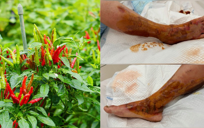 Bác sĩ giã lá ớt đắp vết thương khiến người phụ nữ 65 tuổi nhiễm trùng, hoại tử, nguy cơ mất chân
