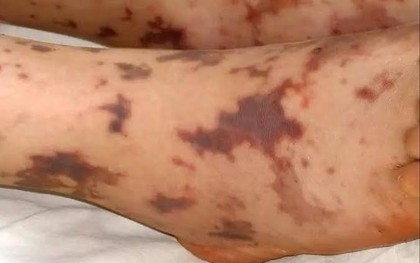 2 ca mắc não mô cầu tại Cà Mau đều đã tử vong