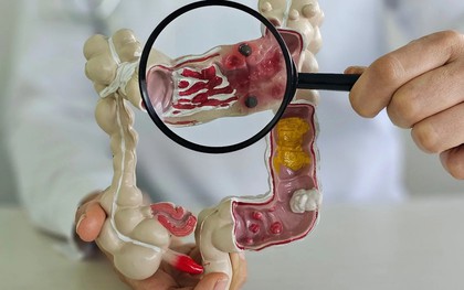Ung thư đại tràng thường "để ý" những người có 2 đặc điểm này: Nếu có cần hành động ngay!
