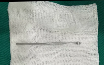 Bé trai 14 tuổi nhập viện vì dị vật dài 12cm trong niệu đạo