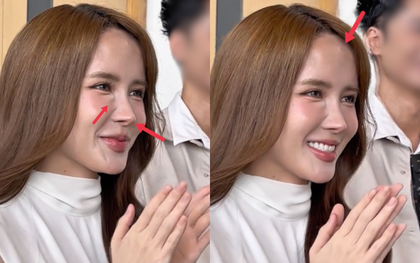 Gương mặt nhiều di chứng thẩm mỹ của Thiều Bảo Trâm đang khiến nhiều người lo lắng
