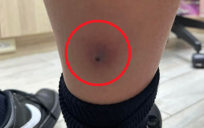 Tưởng chỉ là cúm mùa, bé trai 12 tuổi sốt trở lại: Bác sĩ vén ống quần kiểm tra liền yêu cầu cấp cứu khẩn cấp