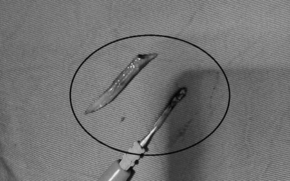 Người đàn ông 41 tuổi đau bụng, bác sĩ sốc phát hiện ra thứ đáng sợ "đi lạc" trong bụng