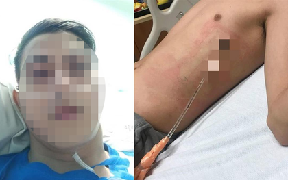 Chỉ vươn vai buổi sáng, nam sinh 17 tuổi bị “xẹp phổi”