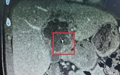 Ca bệnh hiếm gặp: Nội soi lấy dị vật kim loại trong gan