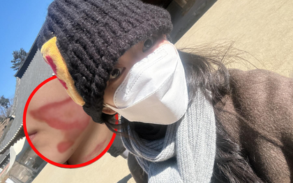 Nữ ca sĩ mất Tết, bị bỏng nặng một bên mặt khi đi làm đẹp