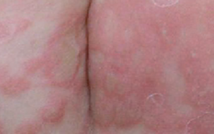 Bé trai 3 tuổi bị giang mai bẩm sinh dù không có triệu chứng