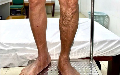 Chân bỗng nổi 'sợi dây thừng' ngoằn ngoèo vì đứng lâu, đi lại nhiều