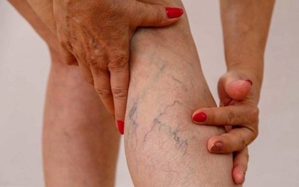 5 điều bác sĩ mạch máu nhắn nhủ bệnh nhân suy giãn tĩnh mạch ăn Tết vui khỏe, hạn chế gặp nhau trong bệnh viện