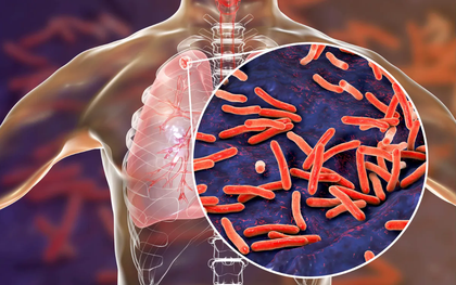 Bộ Y tế đề nghị các địa phương tăng cường phòng, chống lao