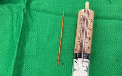 Người đàn ông bụng "cứng như đá" 2 tuần, bác sĩ phát hiện nguyên nhân bất ngờ