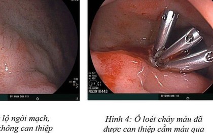 16 tuổi đã xuất huyết dạ dày và cảnh báo từ bác sĩ