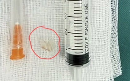 Bé trai 7 tuổi xẹp phổi trái, bác sĩ gắp ra thứ "đáng sợ" bên trong