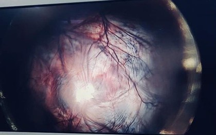 Giữ lại thiên chức làm mẹ cho bệnh nhân 22 tuổi