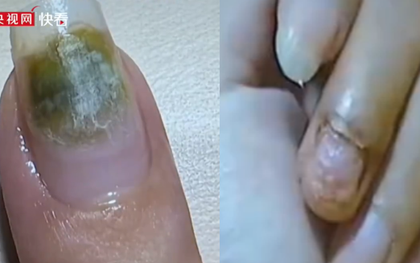 Trung Quốc: Tiệm nail khiến nhiều người nhiễm HPV do khử trùng dụng cụ làm móng qua loa