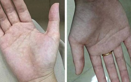 Bàn tay là tín hiệu cảnh báo sức khỏe: 1 thay đổi có thể cho thấy bệnh tiểu đường hoặc xơ gan