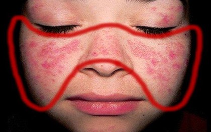 Bệnh nhân lupus ban đỏ nhận TIN VUI ngay đầu năm mới