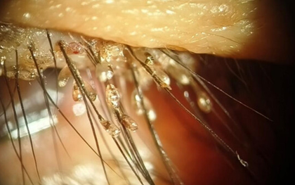 Cô gái "nuôi đàn rận" trên mí mắt không hay biết sau khi làm đẹp bằng phương pháp nhiều chị em cực mê