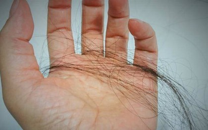 Một phụ nữ giảm được 10kg nhưng lại bị hói đầu: Bác sĩ tiết lộ 4 nguyên nhân chính không ai ngờ