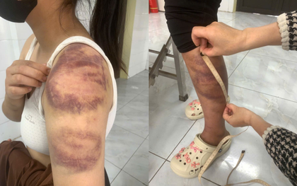 Phẫn nộ ở Bắc Ninh: Gã đàn ông 32 tuổi trói con gái 13 tuổi đánh bầm tím khắp người, vợ mang thai cũng không tha