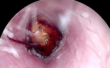Cháu bé đau tai dữ dội, bác sĩ sốc ngang phát hiện bí mật "đáng sợ" bên trong