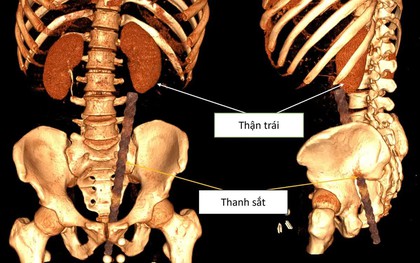 Dị vật xuyên thấu bụng do tai nạn hy hữu