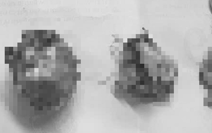 Người phụ nữ 66 tuổi đau bụng kéo dài, bác sĩ gắp ra thứ "đáng sợ"