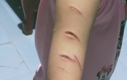 Hé lộ nguyên nhân học sinh lớp 5 bị chị họ dùng dao rạch nhiều nhát lên tay