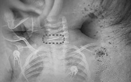 Bé trai bị sốt và co giật, bác sĩ phát hiện ra điều đáng sợ