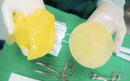 Bác sĩ cảnh báo KHẨN: Người chơi pickleball gặp 5 dấu hiệu này có thể đang vỡ túi ngực