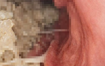 Người phụ nữ 54 tuổi "liệt dạ dày", nhịn 12 tiếng thức ăn trong bụng vẫn còn nguyên vì dùng 1 thứ để giảm cân