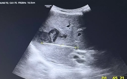 Nguy kịch tính mạng vì thói quen phổ biến sau bữa ăn của người Việt