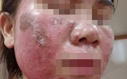 'Vỡ mộng' da đẹp đón Tết: Tan nát mặt vì tự peel da theo hướng dẫn trên mạng